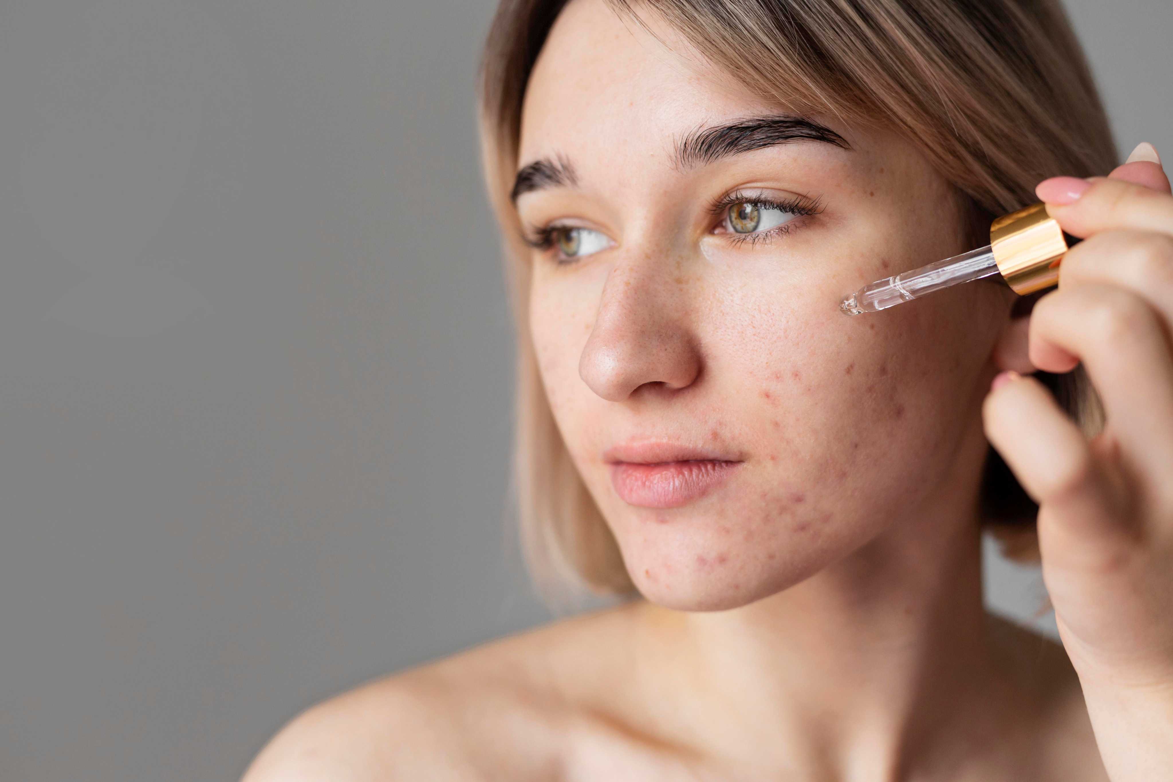 Complete Skincare Routine for Acne-Prone Skin (Dermatologist-Approved)